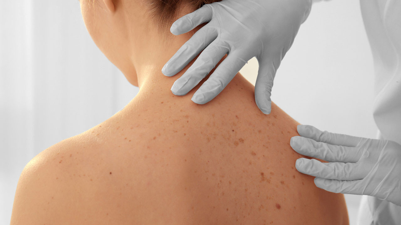 Cilt kanserine duvar ören 2 besini uzmanlar anlattı