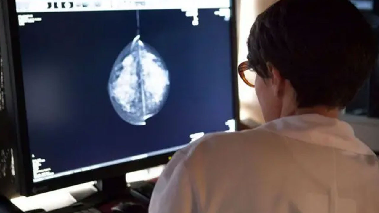 Meme kanserinde yapay zeka devrimi! Uzmanlar anlattı