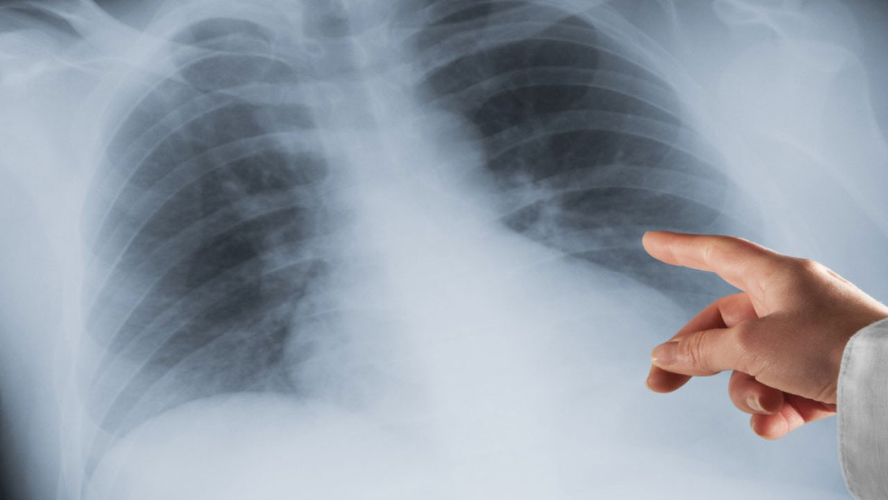 Akciğer kanseri kadınlarda vites artırdı! Uzmanlar anlattı