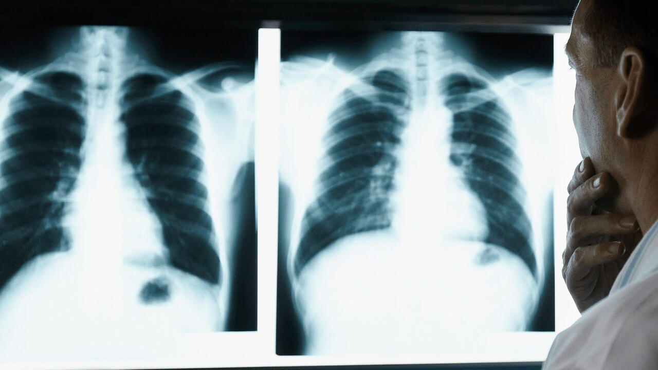 Sessiz katile karşı bilinç kalkanı! Akciğer kanserinde yeni önleme stratejisi masada