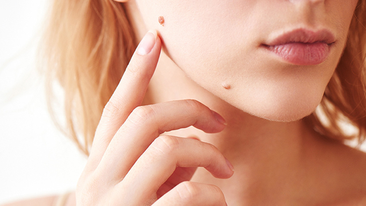 Ciltteki gizemli lekelerin şifresi çözülüyor! Bilim dünyası uyarıyor