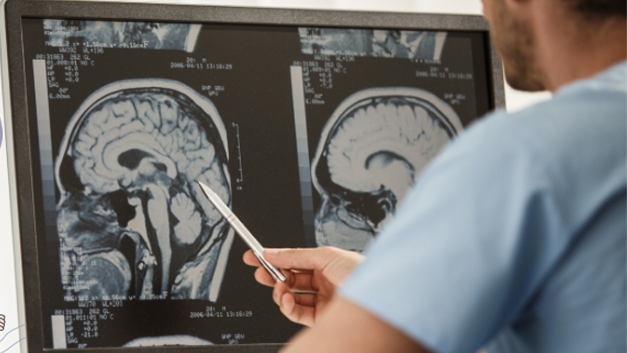Beyin tümörüne mucize tedavi