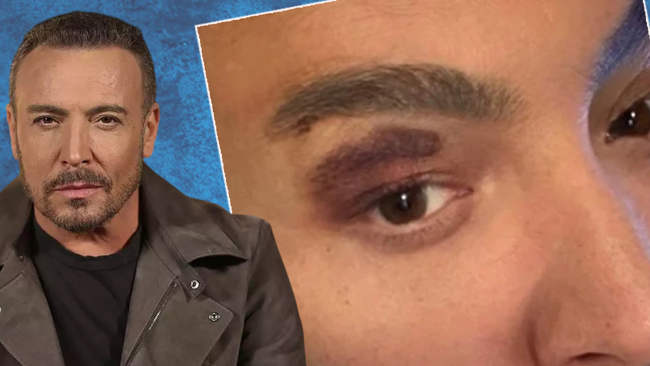 Ünlü şarkıcı Cenk Eren sahnede kaza geçirdi! Gözündeki morluk endişelendirdi