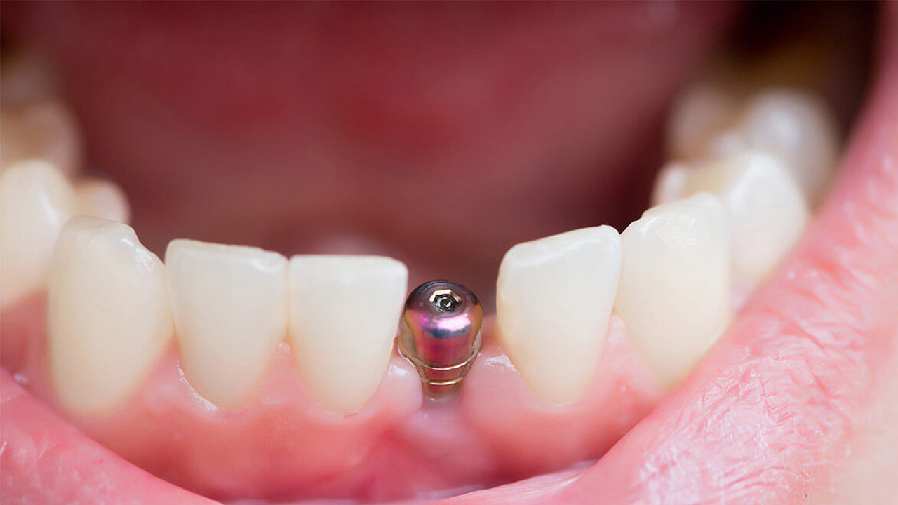 İmplant tedavisi Meclis gündeminde!