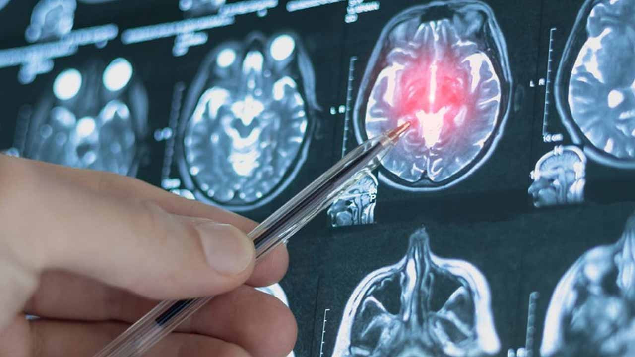 Bilim dünyası, beynin sırlı dönüşüm yaşlarını açıkladı