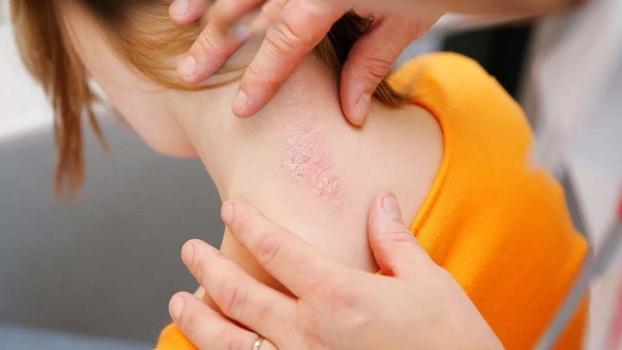 Sedef hastalığına iyi gelen bitki