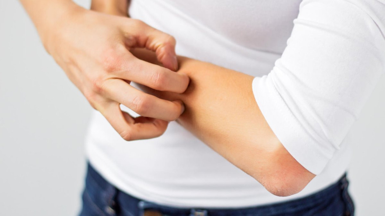 Egzama hastalığına iyi gelen mucize bitki