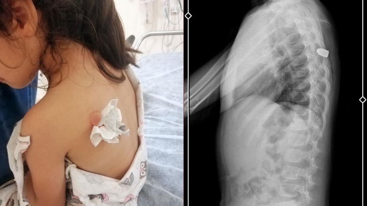 6 yaşındaki Meliha sırtını ‘böcek ısırdı’ sanıyor ama maganda kurşunu bu kez ona isabet etti