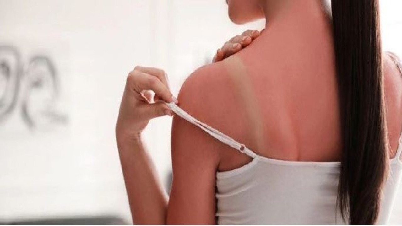 Güneş yanığına karşı 10 kritik kural. Dermatoloji uzmanı açıkladı