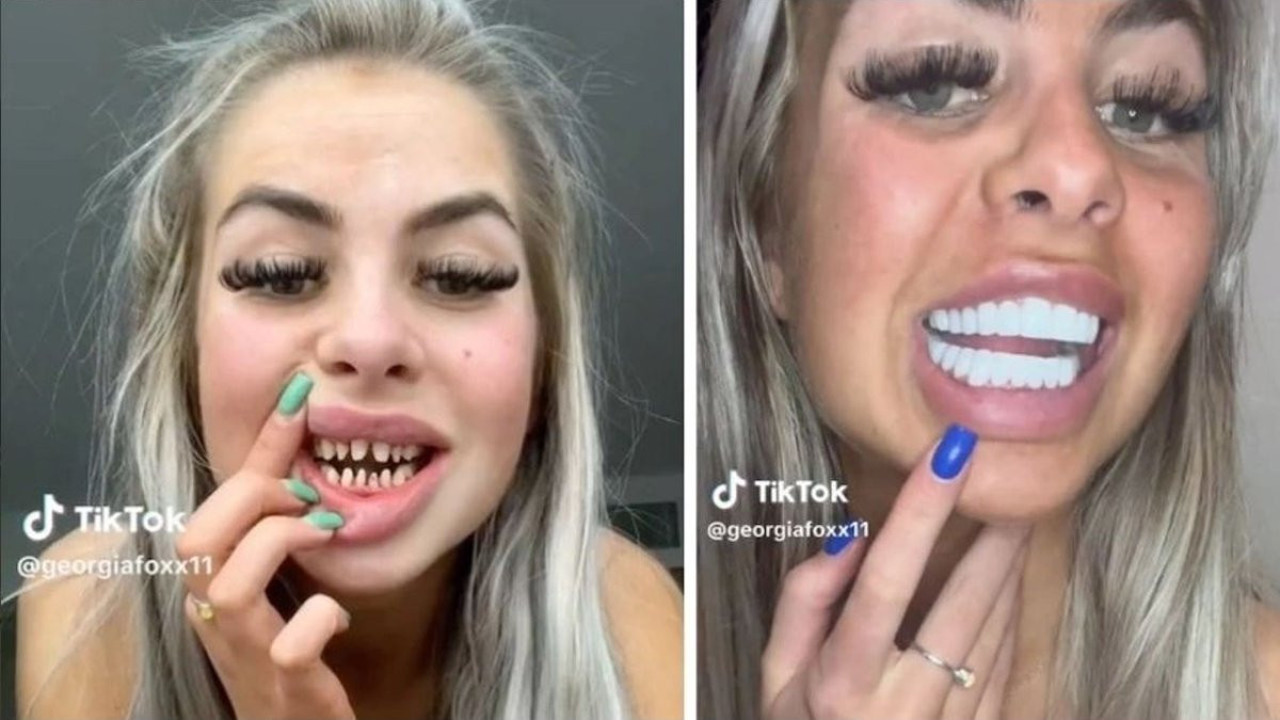 İngiliz fenomen Georgia Fox dişlerini paylaştı: Türkiye'yi öve öve bitiremedi