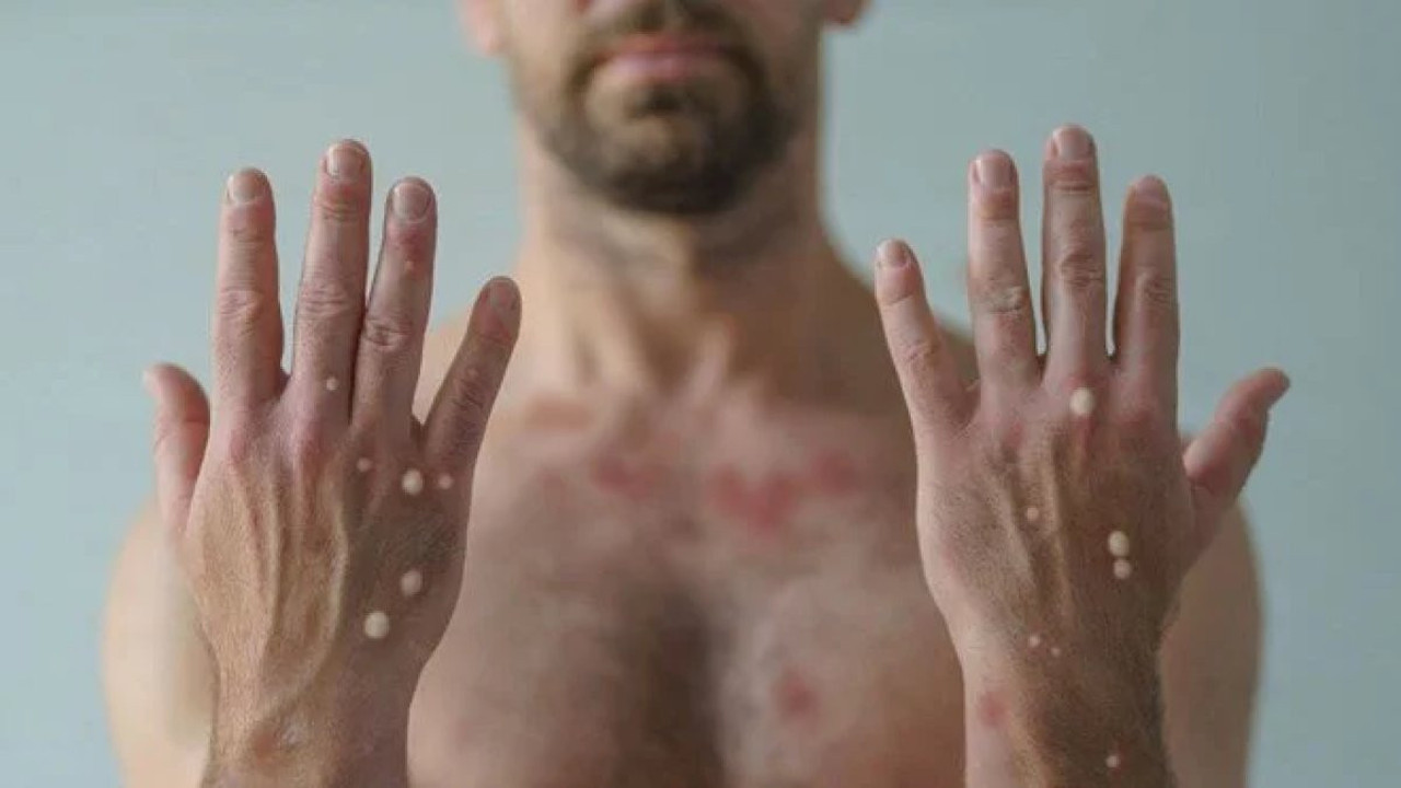 DSÖ’den ‘yeni virüs tehdidi’ açıklaması: Vaka sayısı 100 bine dayandı, ölü sayısı 156 oldu