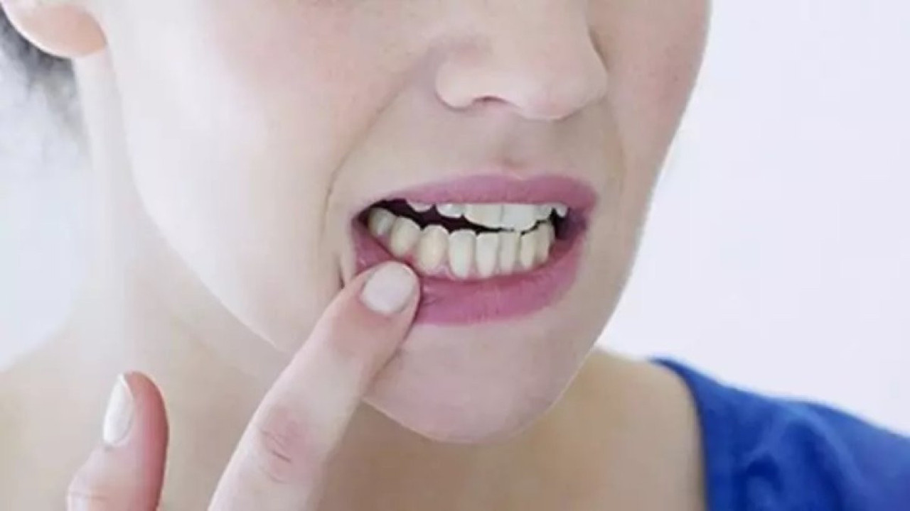 Ağız yaralarını 1 saat içinde yok eden tarif ortaya çıktı. 1 yemek kaşığı yetiyor