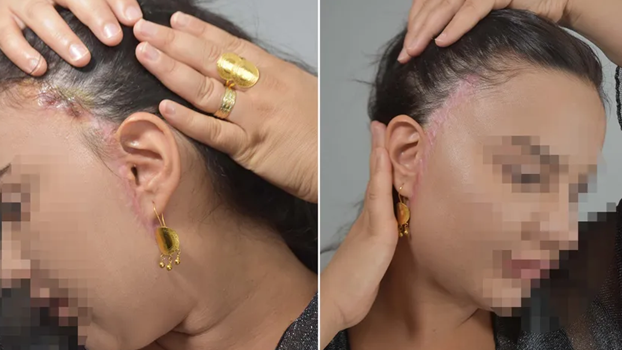 'Badem göz' ameliyatı faciaya yol açtı. 'İnanılmaz acılar çektim, evde günlerce ağladım'