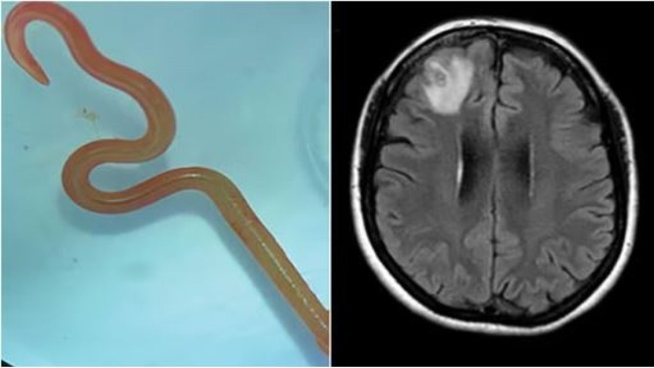 Unutkanlık ve depresyon şikayetiyle hastaneye gitti. Beyninden solucan çıktı
