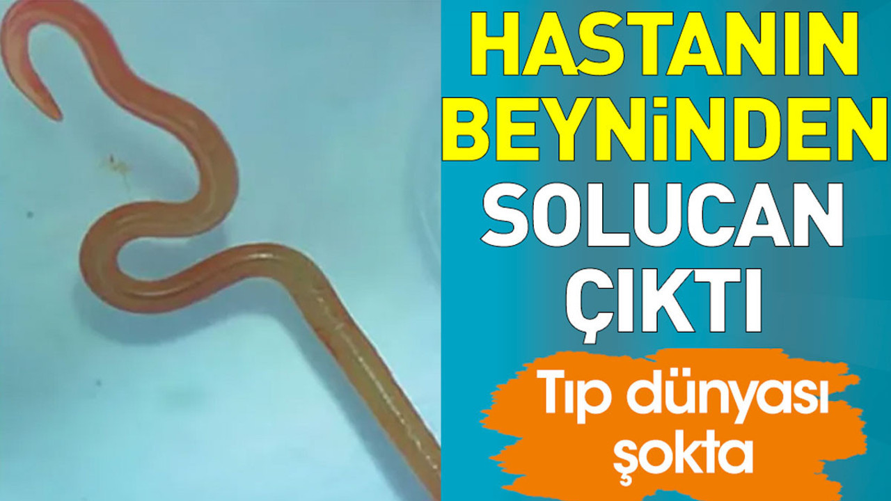 Hastanın beyninden solucan çıktı. Tıp dünyası şokta