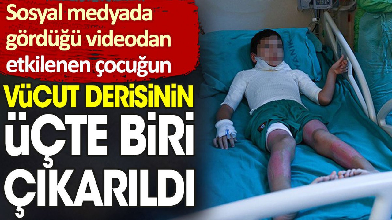 Sosyal medyada gördüğü videodan etkilenen çocuğun vücut derisinin üçte biri çıkarıldı