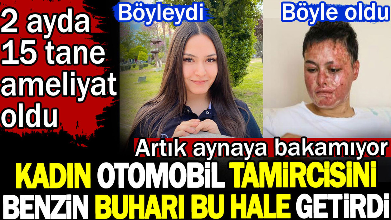 Kadın otomobil tamircisini benzin buharı bu hale getirdi. Artık aynaya bakamıyor. 2 ayda 15 tane ameliyat oldu