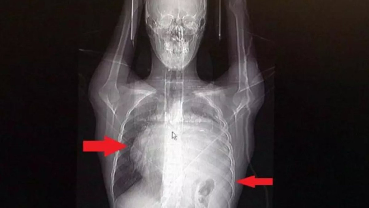 Kalbi 12 santim kaydı akciğeri kâğıt gibi ezildi. İnanılmaz ama gerçek