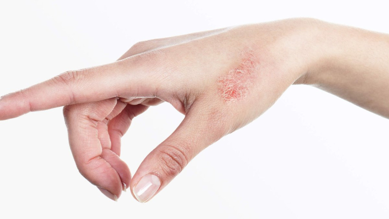 Sedef başka ağır hastalıklara davetiye çıkarıyor