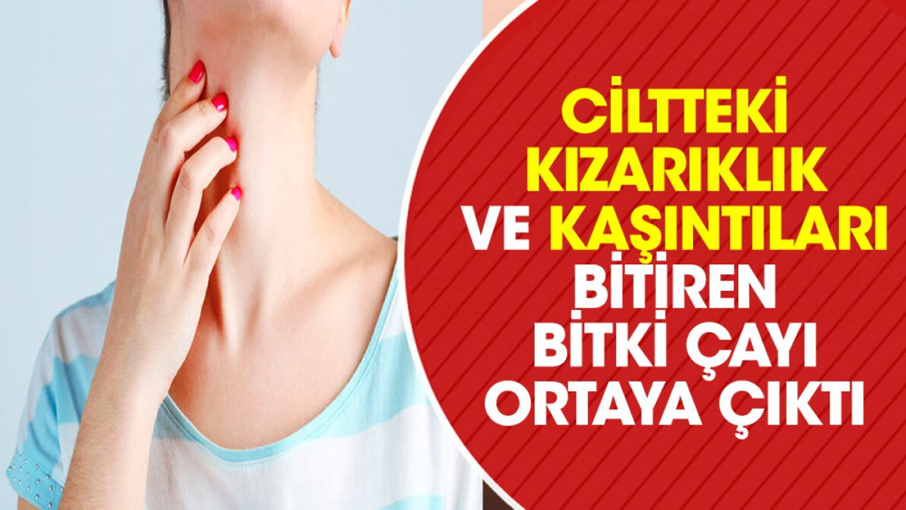 Ciltteki kızarıklık ve kaşıntıları bitiren bitki çayı ortaya çıktı