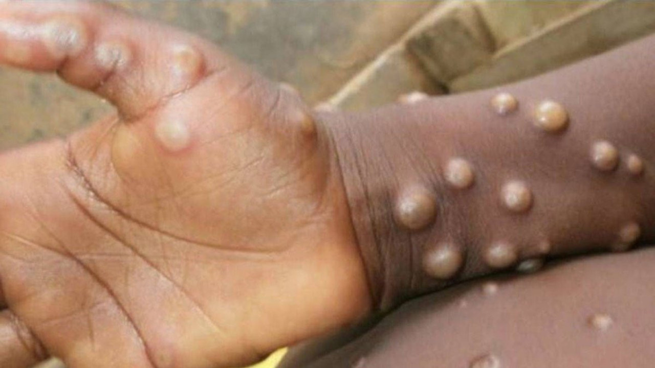 Kongo'da maymun çiçeği alarmı. 581 kişi öldü