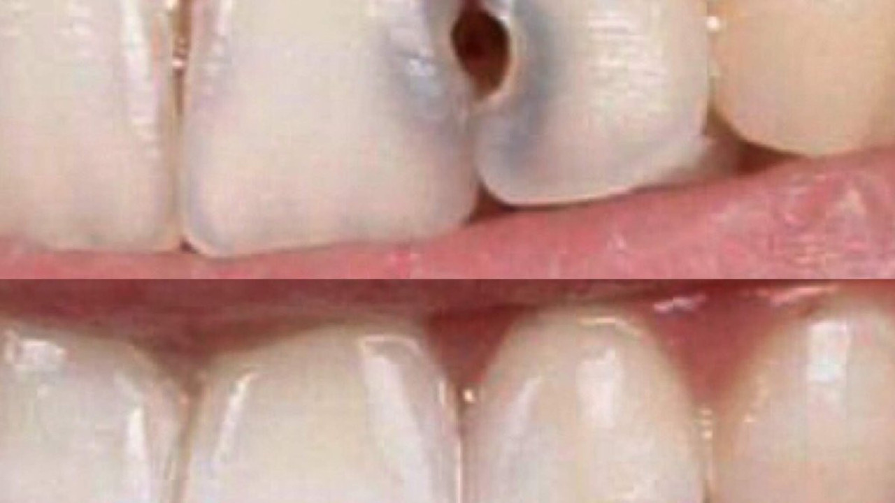 Dişlerinize ne yaparsanız çürümez