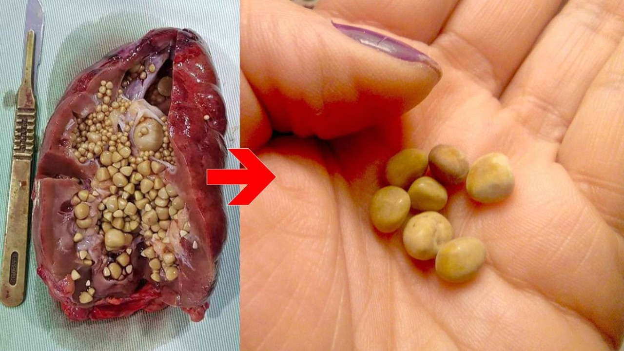 Bu taşlar böbreği yok edebilir