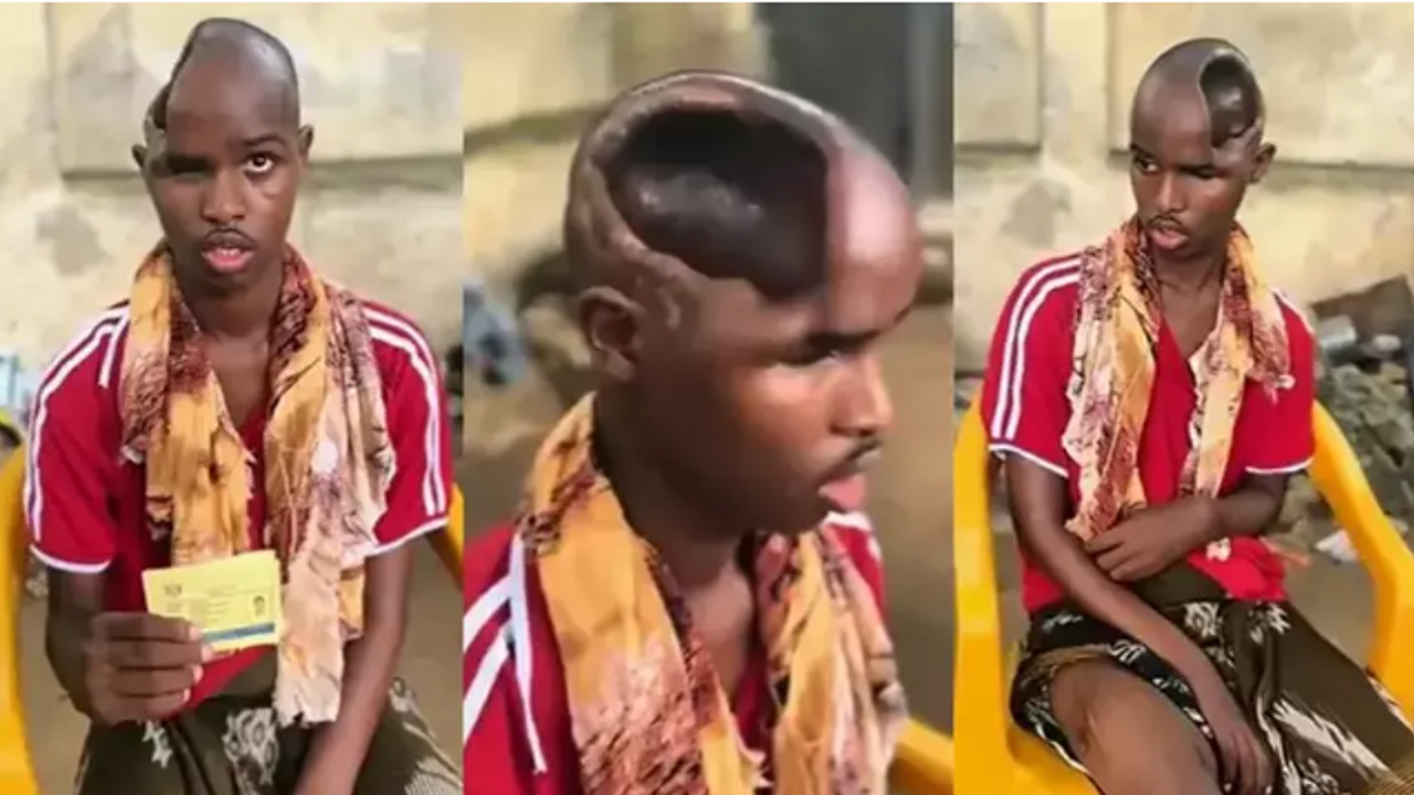 Beyni olmayan adam görenleri şoke etti. ‘Gizli yetenekleri ortaya çıkabilir’