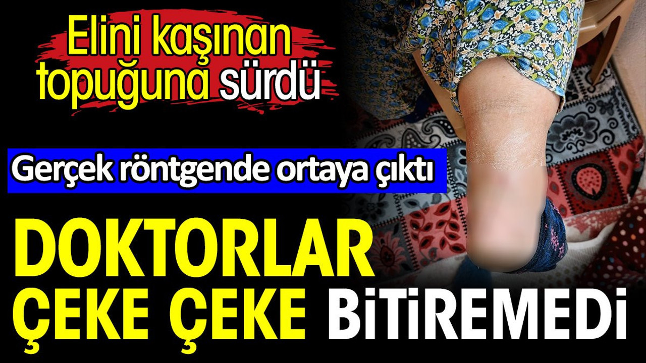Elini kaşınan topuğuna sürdü. Gerçek röntgende ortaya çıktı. Doktorlar çeke çeke bitiremedi
