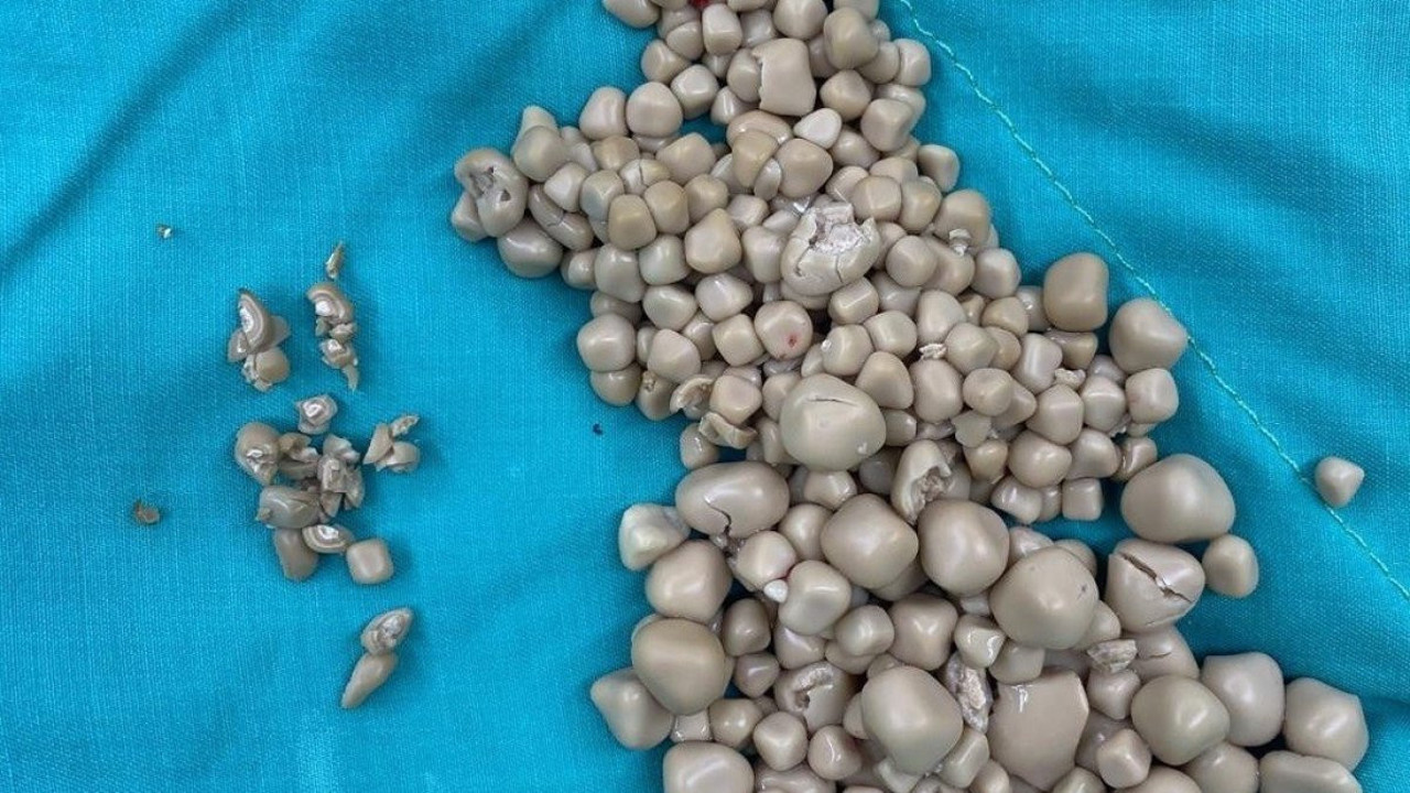 Sırt ağrısıyla gitti. 300 taş çıkarıldı