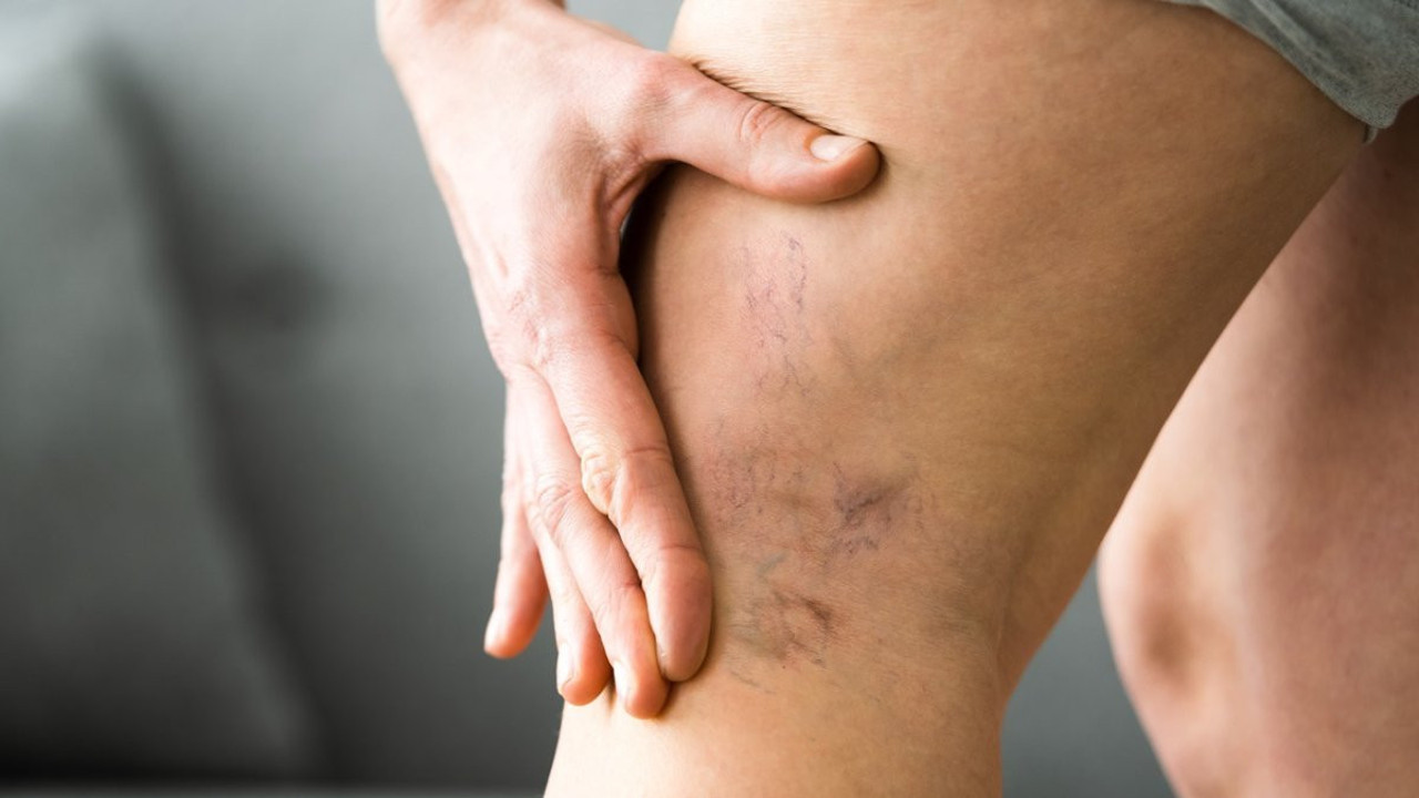 Varis nedir? Varis tedavi yöntemleri neler?