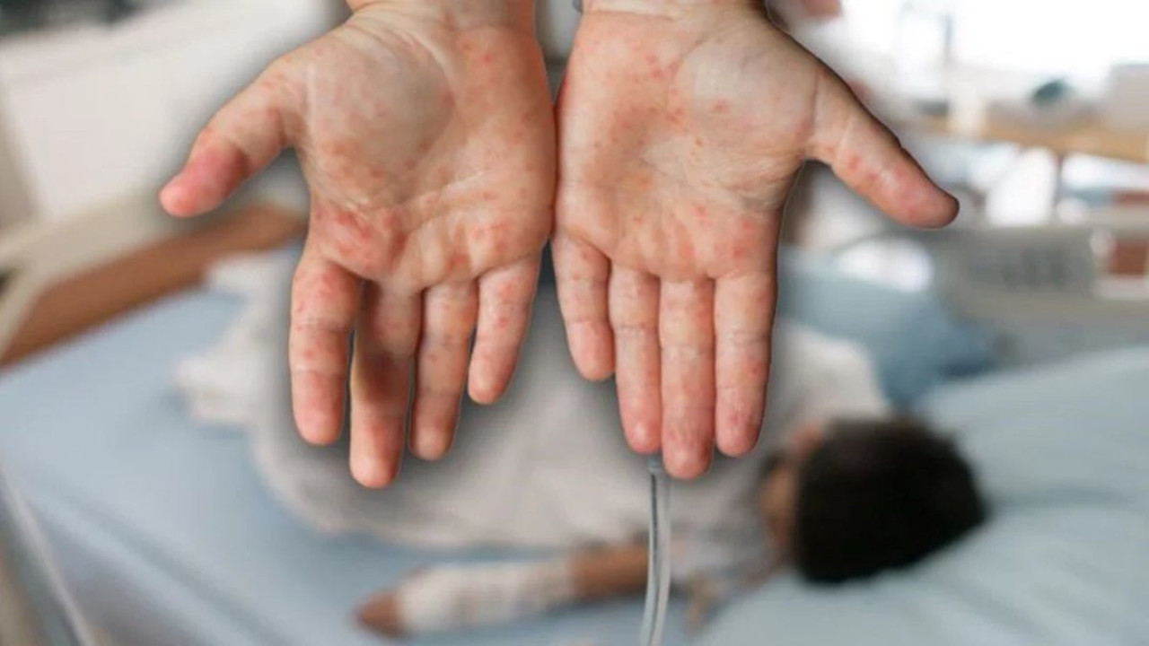 Yunanistan kızamık vakalarına karşı önlem aldı