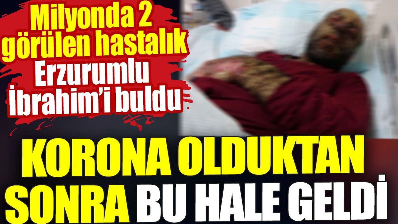 Korona olduktan sonra bu hale geldi. Milyonda 2 görülen hastalık Erzurumlu İbrahim’i buldu