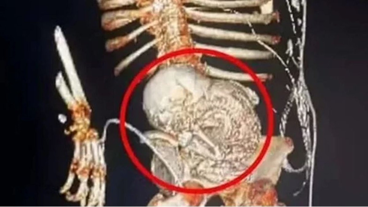 Ölü bebeğini 56 yıl karnında taşıdı. Evladından ayrıldığı gün hayatını kaybetti