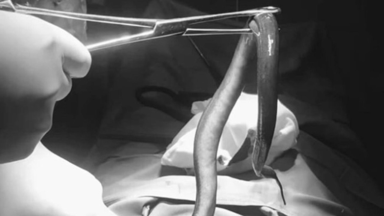 Karın ağrısıyla gitti karnından 30 cm yılan balığı çıktı. Vücuduna girdiği yer doktorları şaşkına çevirdi
