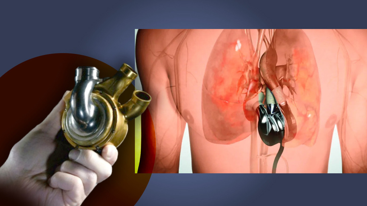 Tıp tarihinde devrim! Kalp nakli olana kadar yapay kalp ile aylarca yaşadı