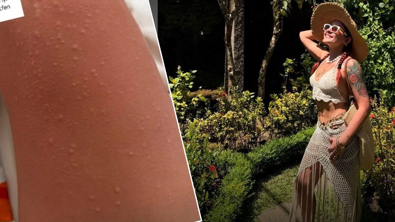 Melek Mosso alerji olduğunu söylemişti! Hastalığı bambaşka çıktı, sudan bulaşıyor