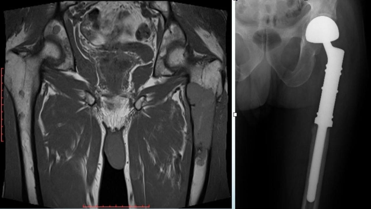 Kemik ve organ sağlığını tehdit eden hastalığa karşı çığır açan tedaviler