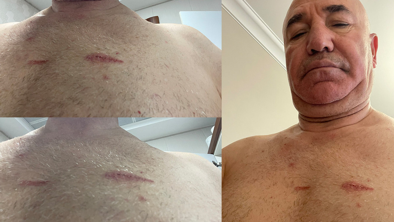 CHP'li Tanal polis şiddetinin izlerini paylaştı