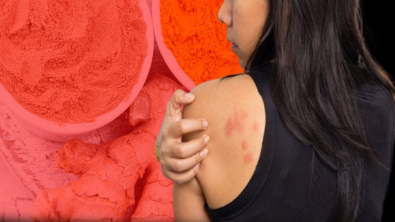 Kurdeşen kabusuna son veren 5 besin! Hayatınızı karartan sorun bitecek