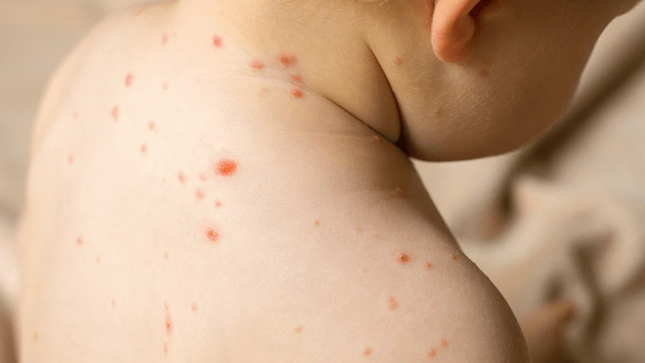 Kızamık vakaları hızla artıyor! 1 can daha aldı