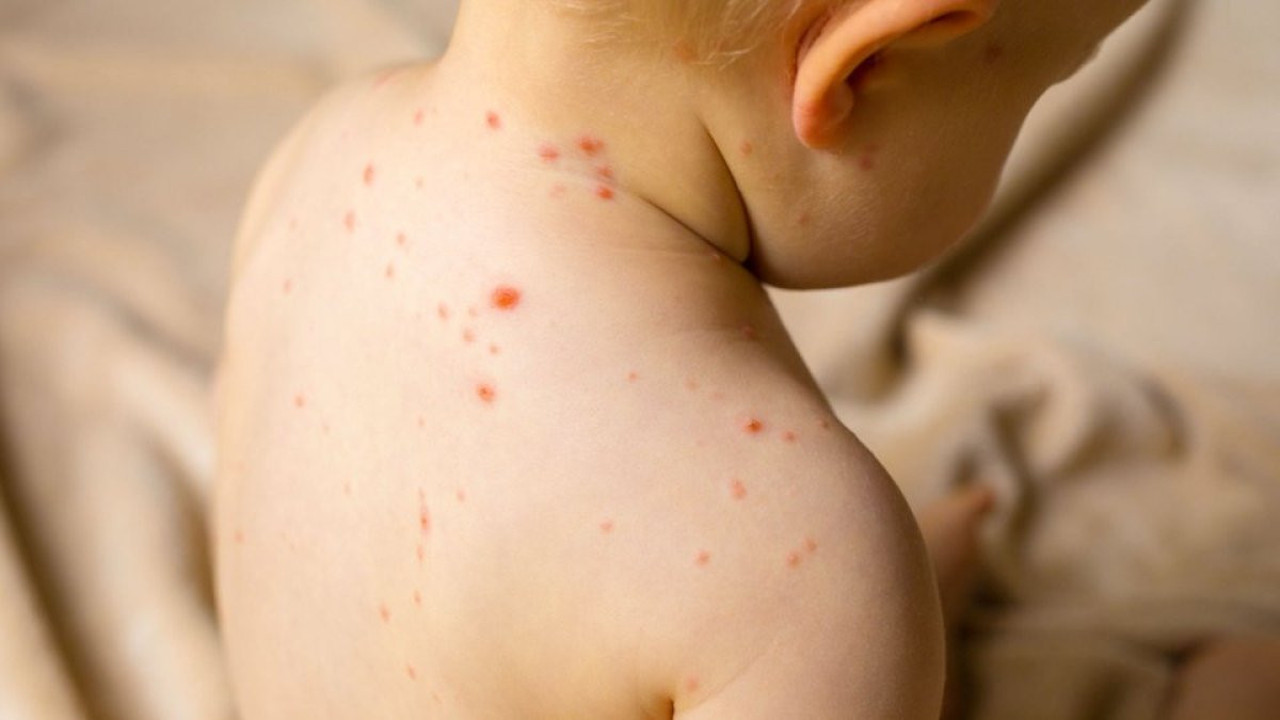 ABD'de salgın alarmı! Vaka sayısı 935'e çıktı