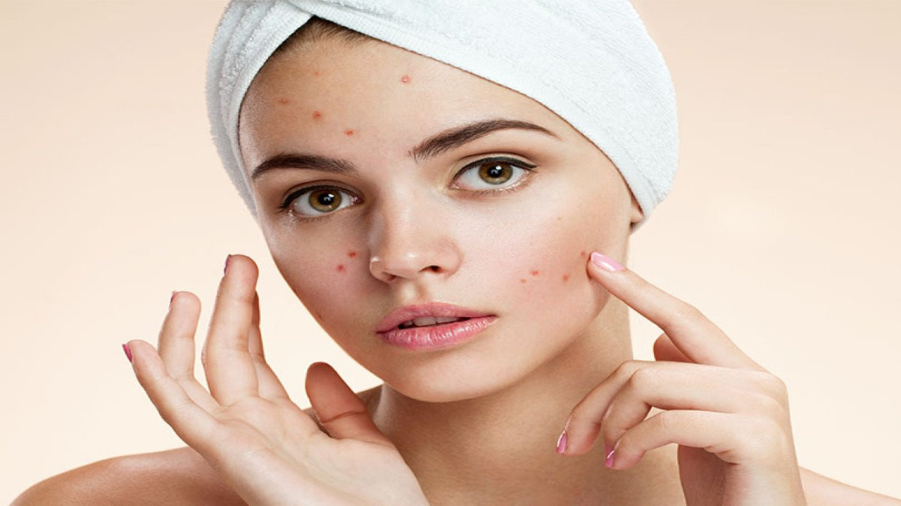 Sivilceyi bitiren üç ot! Sivilceye karşı bitkisel devrim