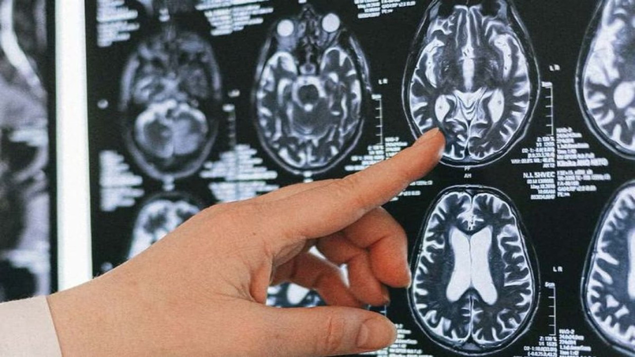 Beyindeki davetsiz misafir tehlike saçıyor! Uzmanlar anlattı