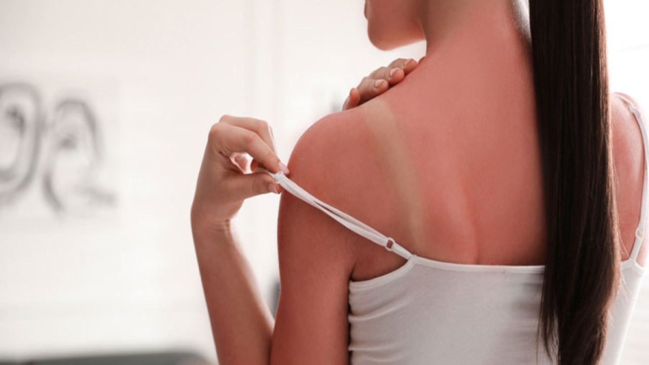 Cildiniz alarm veriyor! Güneş yanıklarına dikkat