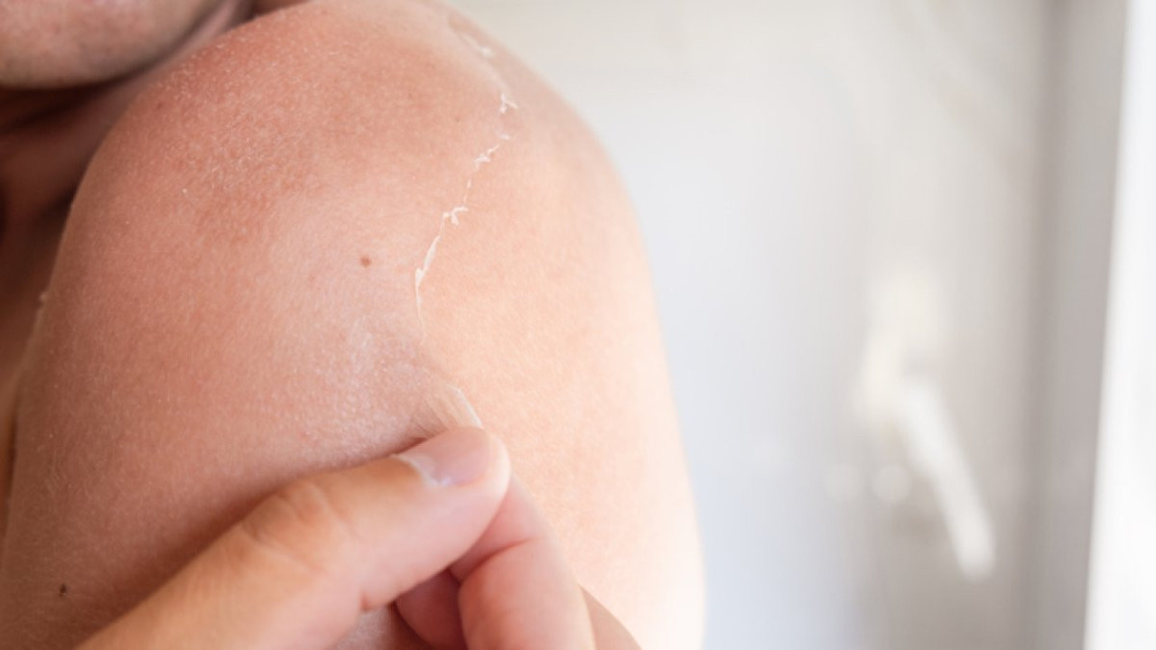 Cildiniz soyuluyorsa dikkat! Güneş yanığının gizli tehlikesi