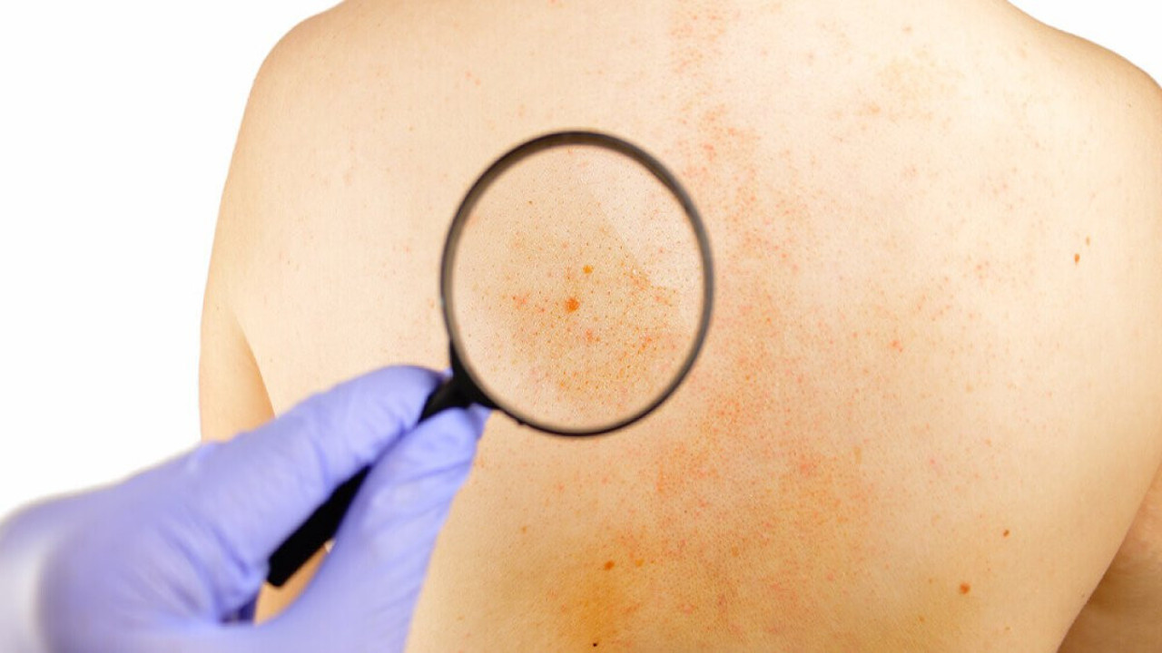 Cildinizdeki gizli tehlike! İki belirti hayatınızı değiştirebilir