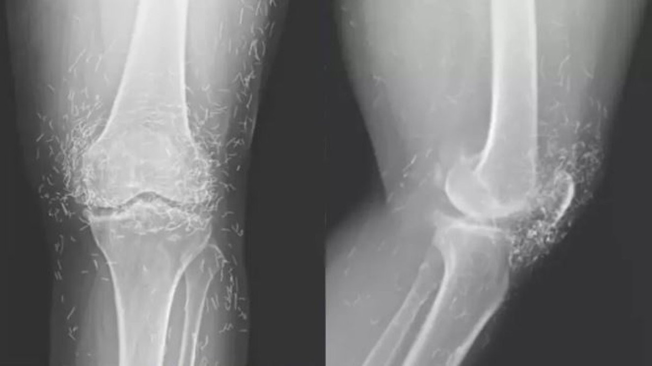 Diz ağrısı şikayetiyle hastaneye gitti: Röntgende ortaya çıkanlar doktorları şaşkına çevirdi!