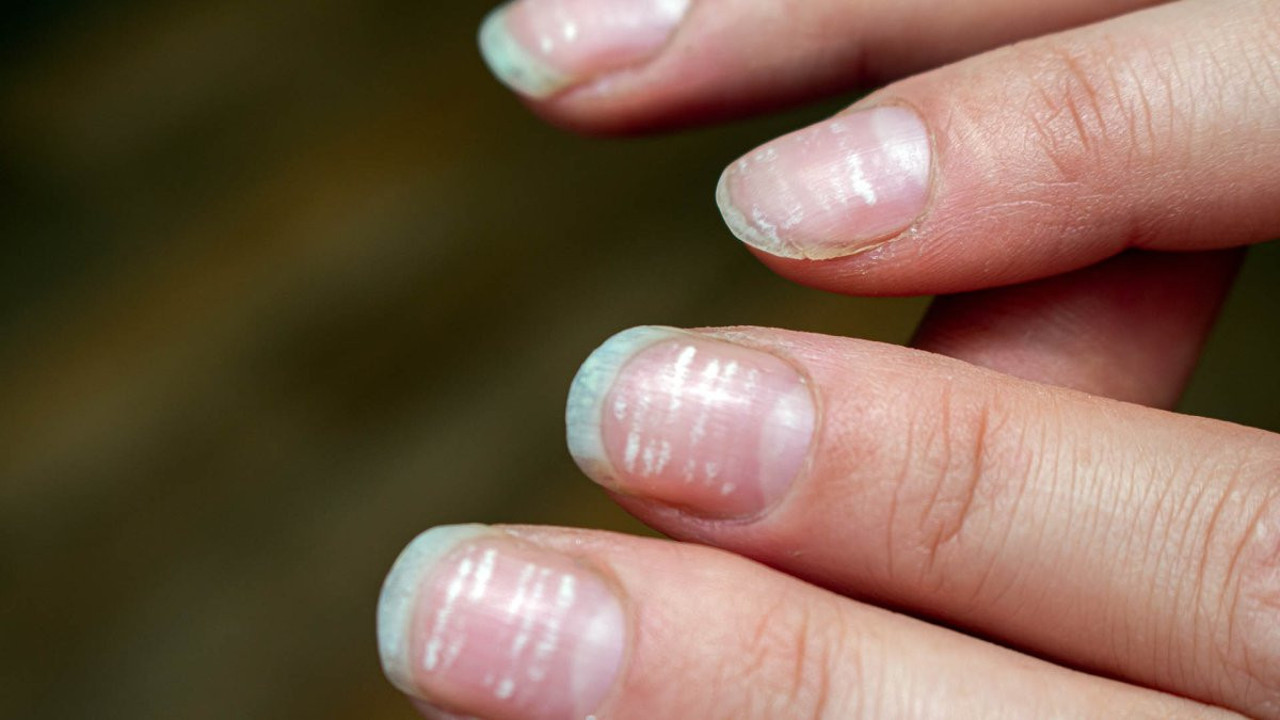 Demir eksikliğinin gizli yüzü! Vücudun alarmı