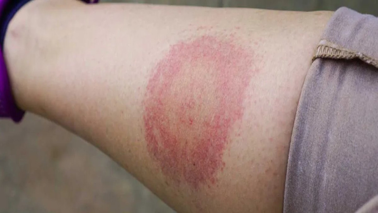 Lyme tedavisinde karanlık gerçek! Kalıcı semptomlar neden kaçınılmaz?